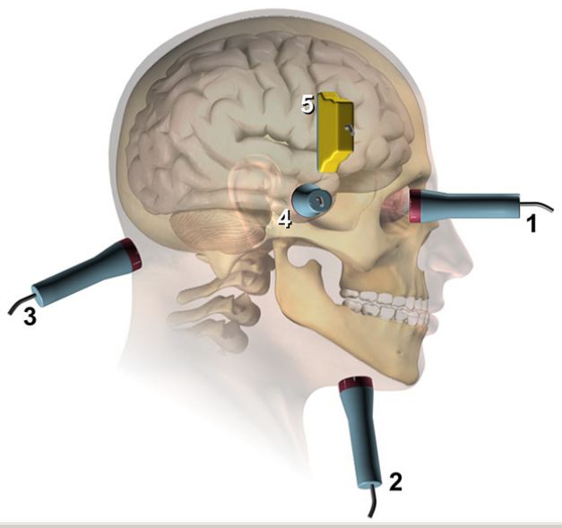 transcranial_ultrasound transcranial_ultrasound