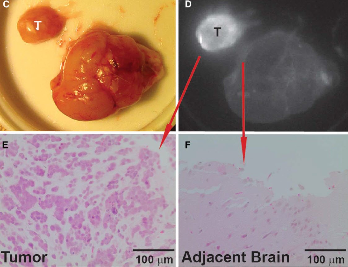 tumor fluorescence